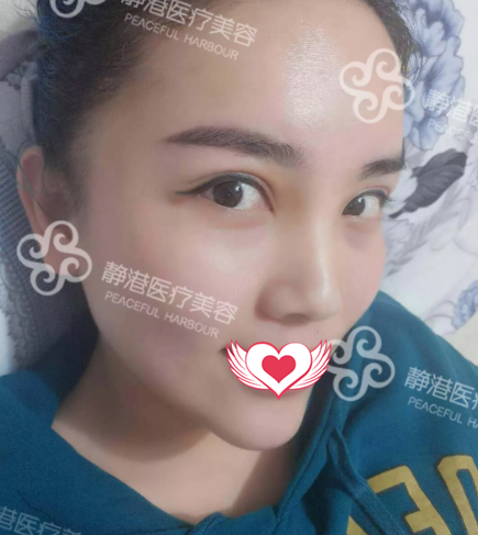 面部苍老的我找沧州静港季泽东院长做自体脂肪填充后瞬变妙龄少女 案例图2