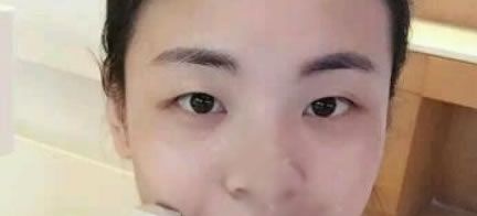 台州黄岩昊阳整形王文波做双眼皮效果怎么样,国庆刚找他割双眼皮开眼角了