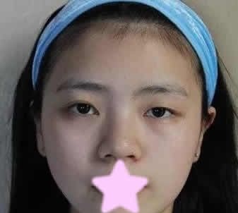 不知道长治天成和悦美哪个医院好?冲着悦美整形价格实惠找薛艳峰做了全切双眼皮+开眼角