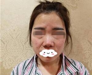 邵阳哪家整形美容医院靠谱?看我在朋友推荐的曹家整形美容医院做的肋软骨隆鼻一个月的恢复过程