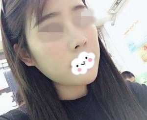 邵阳哪家整形美容医院靠谱?看我在朋友推荐的曹家整形美容医院做的肋软骨隆鼻一个月的恢复过程 图2