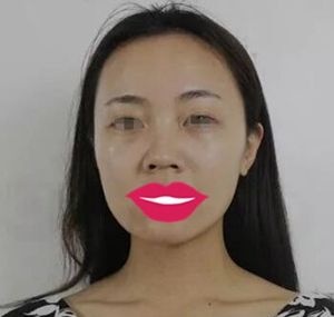 妹子在驻马店美兰德做了鼻综合一个月就基本看不到疤痕了 手术费用还不高