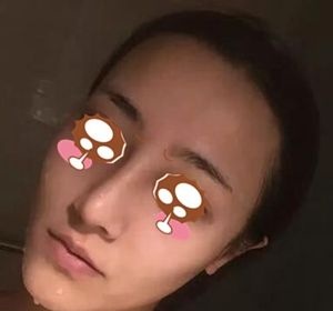 妹子在驻马店美兰德做了鼻综合一个月就基本看不到疤痕了 手术费用还不高 图2