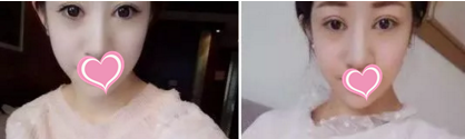 大连爱德丽格做双眼皮多少钱?刘志刚做双眼皮失败修复8000元起附真人案例照片 图2