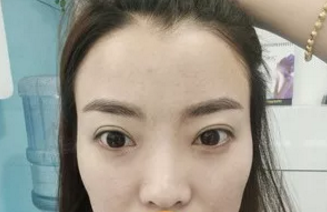 为在烟台做个自体脂肪填充面部手术，我快跑完所有医院了