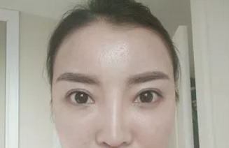 为在烟台做个自体脂肪填充面部手术,我快跑完所有医院了 图2