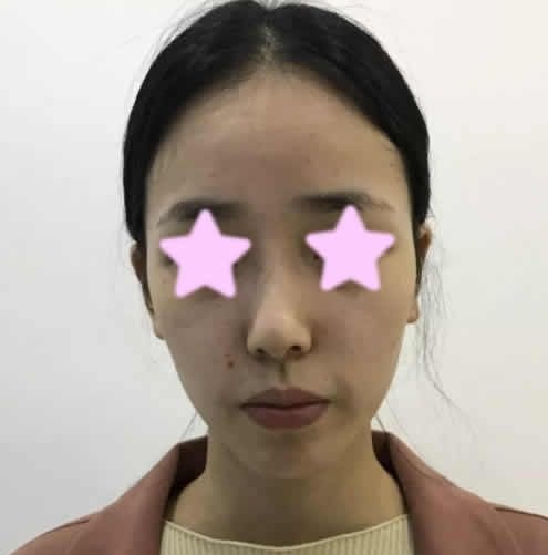 说说我找长治悦美整形薛艳峰院长做鼻综合价格及术后18天恢复效果