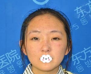 安徽双眼皮失败修复哪家好?我让排名前十整形医院阜阳东方美莱坞勇中华修复