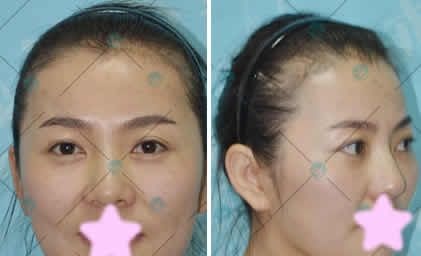 80后的我在大同清木整形做全脸线雕提升术恢复一周后美过18岁,大家都说这钱花的值