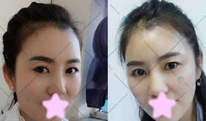 80后的我在大同清木整形做全脸线雕提升术恢复一周后美过18岁,大家都说这钱花的值 图2