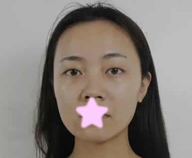 仅仅是让聊城韩美整形倪景辉医生给我做了鼻综合,一个月后整个人都变洋气了