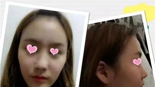 抚州梦婷史希杰给我设计的自体脂肪填充方案是:填充额头+太阳穴+苹果肌+鼻唇沟,来看看术后效果