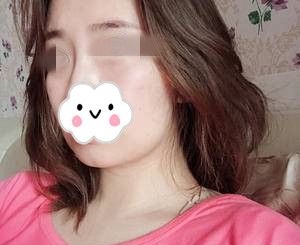 邵阳曹家方明武做全面部年轻化怎么样?分享我V脸埋线提升20天的效果图