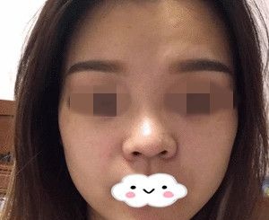慕名而来终于预约到了游鹏飞医生定制隆鼻,20天后真的是超级满意