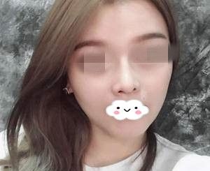 慕名而来终于预约到了游鹏飞医生定制隆鼻,20天后真的是超级满意 图2