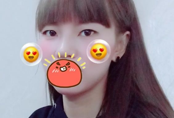 来看看我刚找台州博仕整形张永继院长做的芭比眼综合效果,个人觉得还不赖