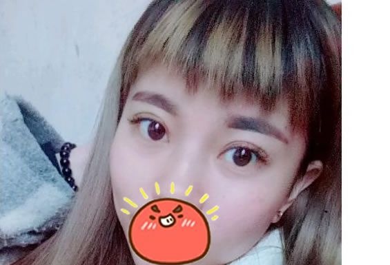 来看看我刚找台州博仕整形张永继院长做的芭比眼综合效果,个人觉得还不赖 图2