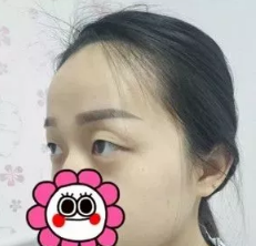 大家都很喜欢我在沧州静港做的自然双眼皮效果 更赞的是术后不会出现又假又肿的肉条状