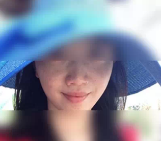 在秦皇岛纪辉做皮秒祛斑12天让我摆脱遗传雀斑 轻松拥有光滑洁白肌肤
