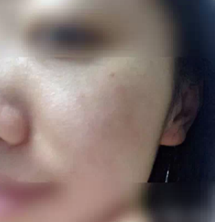在秦皇岛纪辉做皮秒祛斑12天让我摆脱遗传雀斑 轻松拥有光滑洁白肌肤 图2