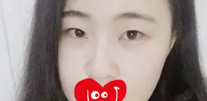 大连整形哪家好?看我花8000元找大连新华美天张井忠割双眼皮2个月的恢复效果