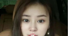 一年了,我把自己在新疆黎美整形许黎那儿做的6.5mm双眼皮术后恢复过程写了下来 图2