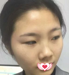 我想要的自然小翘鼻效果 终于找秦皇岛纪辉訾海涛医生做完鼻综合手术实现