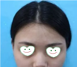 大连新华美天整形医院做隆鼻怎么样?看我做的鼻综合术后30天恢复效果就知道了