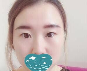丹东哪家割双眼皮好?分享我在富雅华医整形做双眼皮+开眼角术后30天恢复效果图
