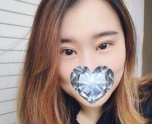 丹东哪家割双眼皮好?分享我在富雅华医整形做双眼皮+开眼角术后30天恢复效果图 图2