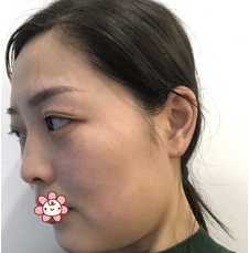 虽说去贵阳美莱整形钱刚那儿做面部吸脂恢复过程有点难熬,但效果我不得不服。