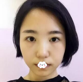 不知无痕去眼袋哪里好?阜阳东方美莱坞去眼袋手术后2个月案例恢复效果图
