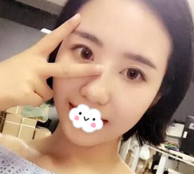 不知无痕去眼袋哪里好?阜阳东方美莱坞去眼袋手术后2个月案例恢复效果图 图2