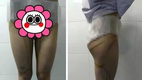 来看我在聊城韩美整形做无痛360水动力腿部吸脂7天恢复图及真实经历