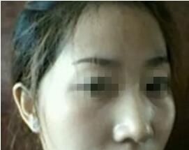 感谢曲靖吴氏嘉美用自体脂肪填充我的额头和太阳穴 不仅解决了凹陷还让我的脸恢复水嫩感