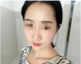 感谢曲靖吴氏嘉美用自体脂肪填充我的额头和太阳穴 不仅解决了凹陷还让我的脸恢复水嫩感 图2