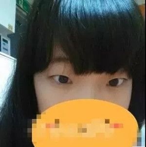 妹子在吉安天使整形医院做双眼皮手术后的恢复日记
