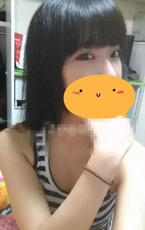 妹子在吉安天使整形医院做双眼皮手术后的恢复日记 图2