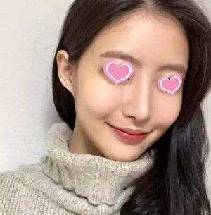 吉安天使整形医院做隆鼻手术怎么样？给大家分享下我手术一个月后的恢复效果 案例图2