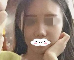 别纠结到底是做硅胶隆鼻还是自体软骨隆鼻？看佳木斯韩艺来的隆鼻真人案例分享