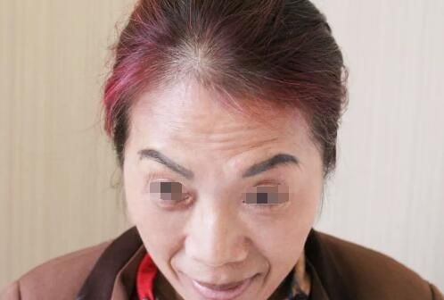 在扬州艾菲斯做玻尿酸+瘦脸除皱联合除皱 一觉醒来告别了法令纹、抬头纹、鱼尾纹、川字纹....