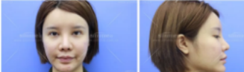 去年花了4000大洋在淄博美冠臣美容医院做了鼻综合手术,从拆线后到现在总是忍不住拍照片