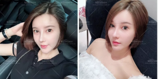 去年花了4000大洋在淄博美冠臣美容医院做了鼻综合手术,从拆线后到现在总是忍不住拍照片 图2