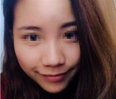 考虑再三,我选择了在四川广元医尔美华美找董甫生做鼻综合,看我隆鼻后得美照