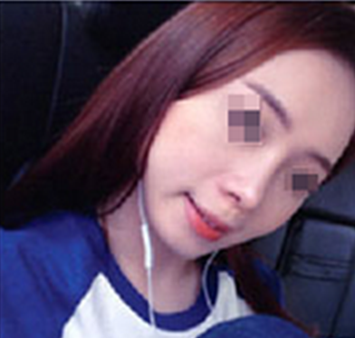考虑再三,我选择了在四川广元医尔美华美找董甫生做鼻综合,看我隆鼻后得美照 图2