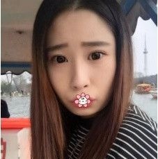 去贵州利美康刘德东那儿做硅胶假体垫下巴时我对医生说:你不是短下巴咋知道我的苦恼!