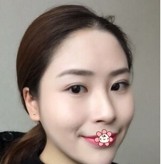 去贵州利美康刘德东那儿做硅胶假体垫下巴时我对医生说:你不是短下巴咋知道我的苦恼! 图2