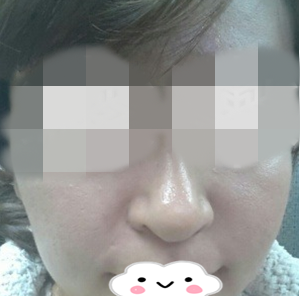 羡慕别人皮肤的我在佳木斯韩艺来做了三次光子嫩肤后达到了白白嫩嫩的效果 图2