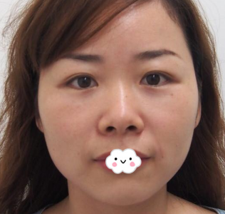 开心!东营艺美李琳膨体隆鼻综合整形将我朝天鼻矫正修复(20天案例恢复图)