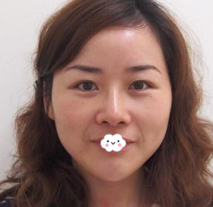 开心!东营艺美李琳膨体隆鼻综合整形将我朝天鼻矫正修复(20天案例恢复图) 图2